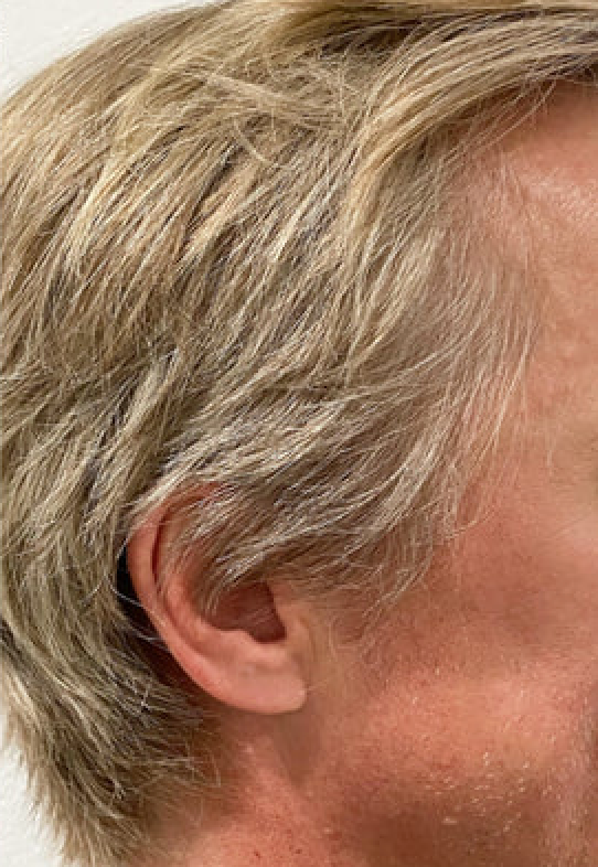 Après traitement